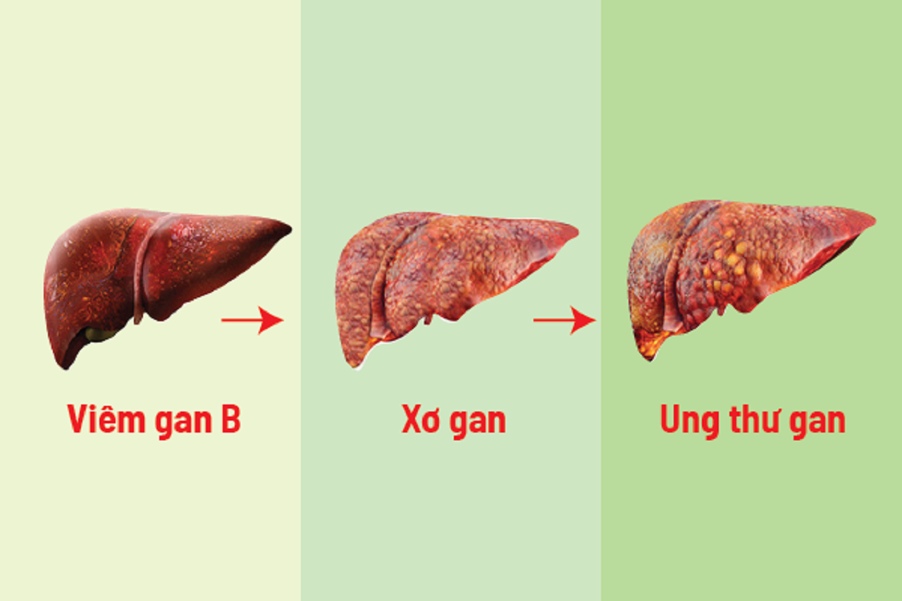 5 lưu ý khi điều trị xơ gan có khỏi được không? 1 Điều trị xơ gan có khỏi được không? Và câu trả lời