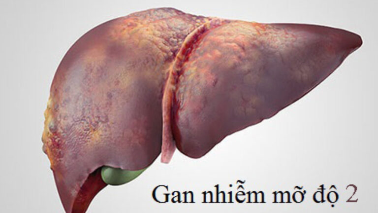 Gan nhiễm mỡ độ 2 có chữa khỏi được không? - Giải đáp 1 Gan Nhiem Mo Do 2 Co Nguy Hiem Khong